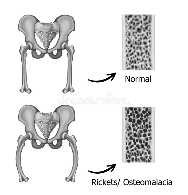 Osteomalacia